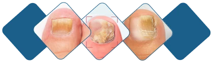 Healthy nails transformation